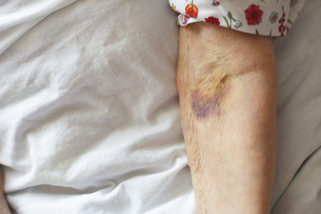 Closeup of bruises on an older person's arm.